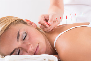 acupuncture, woman's back